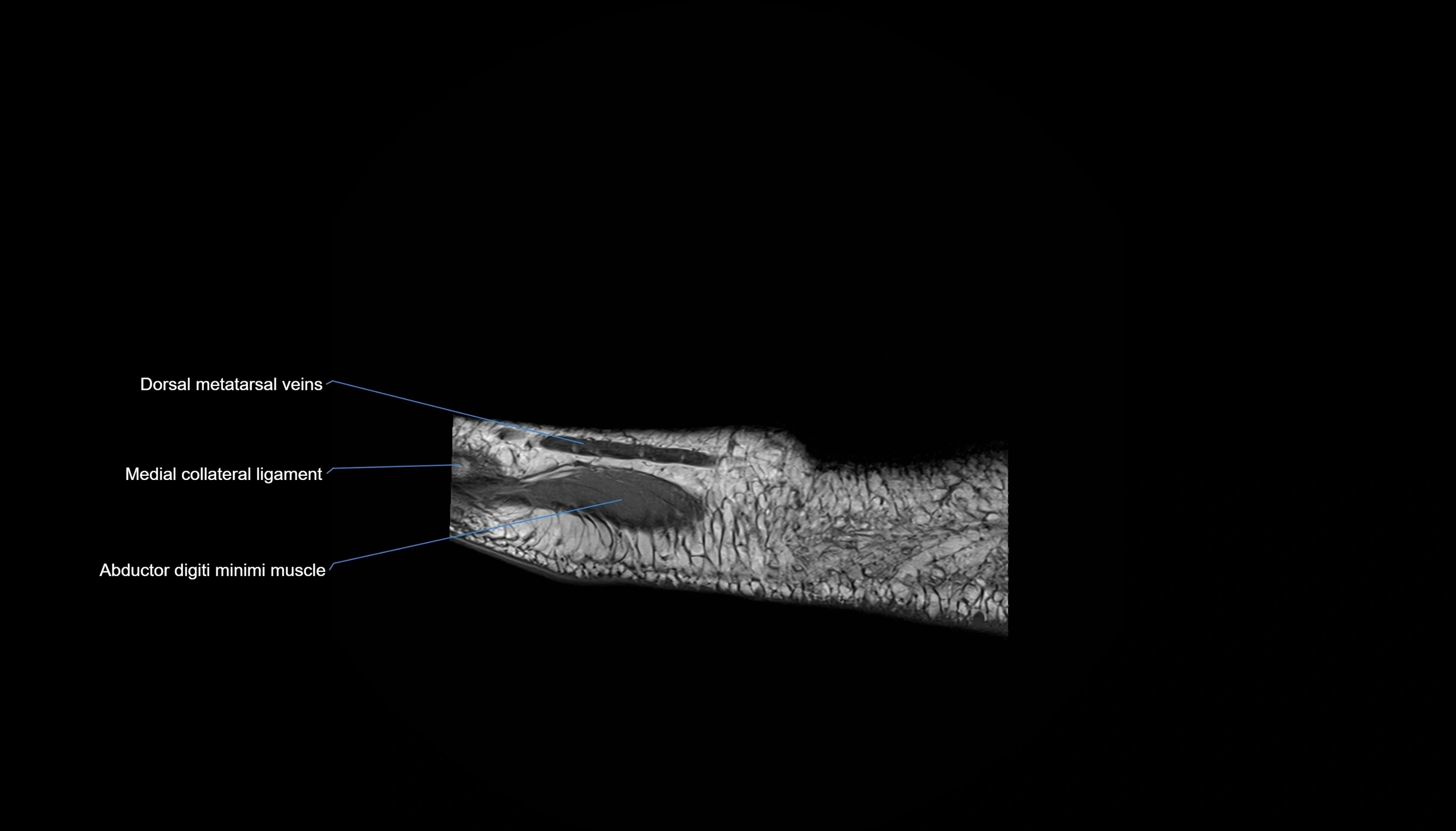 MRI mid foot sagittal cross sectional anatomy 3T  radiology  image-img-00001-00002.webp